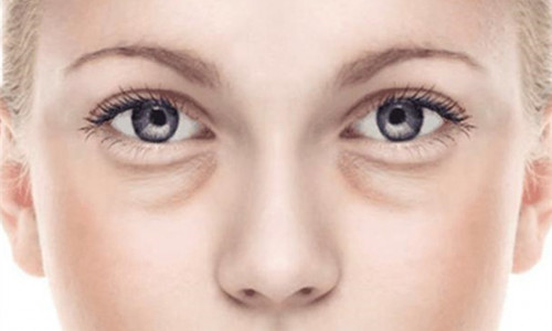 How to eliminate dark circles and eye bags under the eyes